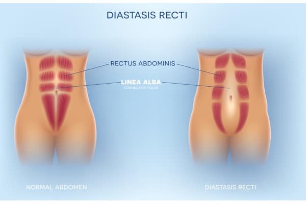 What Non-Surgical Options Are Available for Diastasis Recti Slough?
