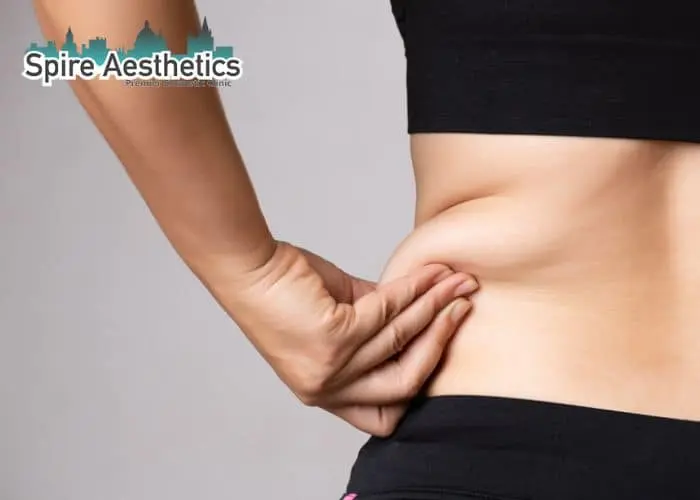Image of woman pinching fat on their hips Slough. Fat Freezing treatment