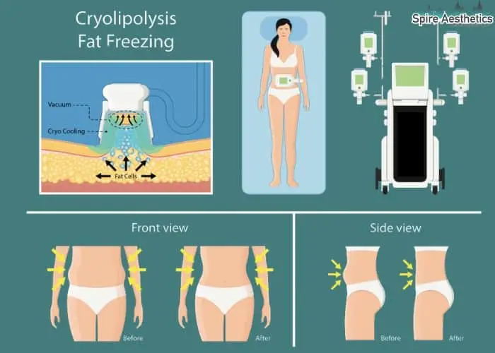 Fat freezing treatment Slough benefits for competitions to remove stubborn fat deposits.