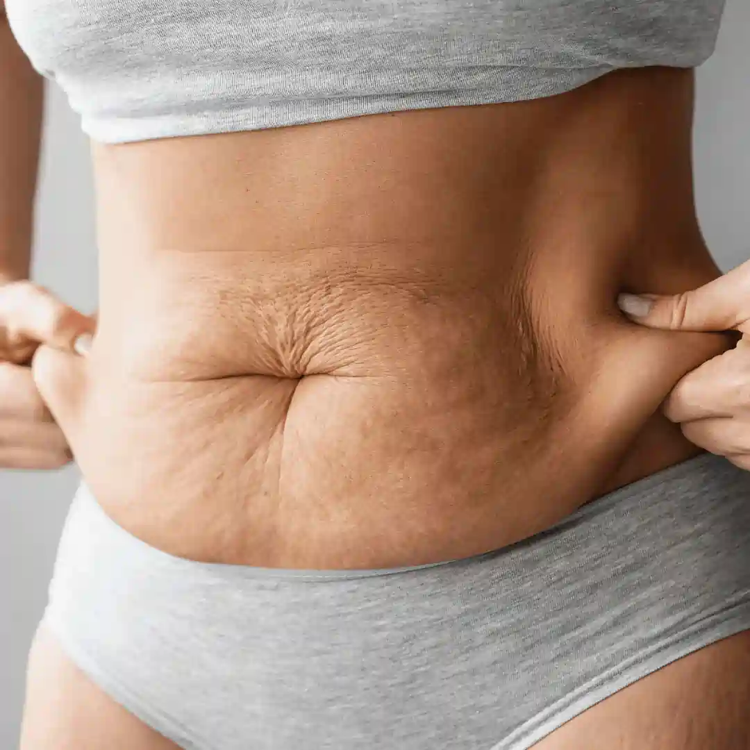 Is It Normal to Have Loose Skin After Pregnancy Slough?