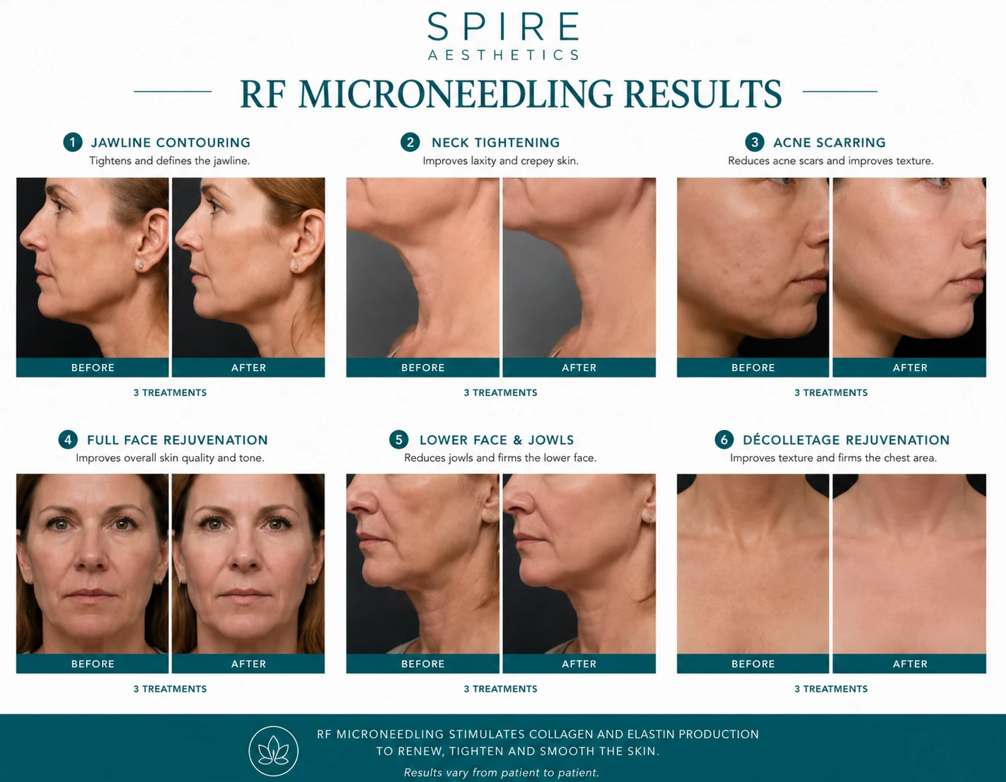 RF Microneedling Skin tightening Slough results