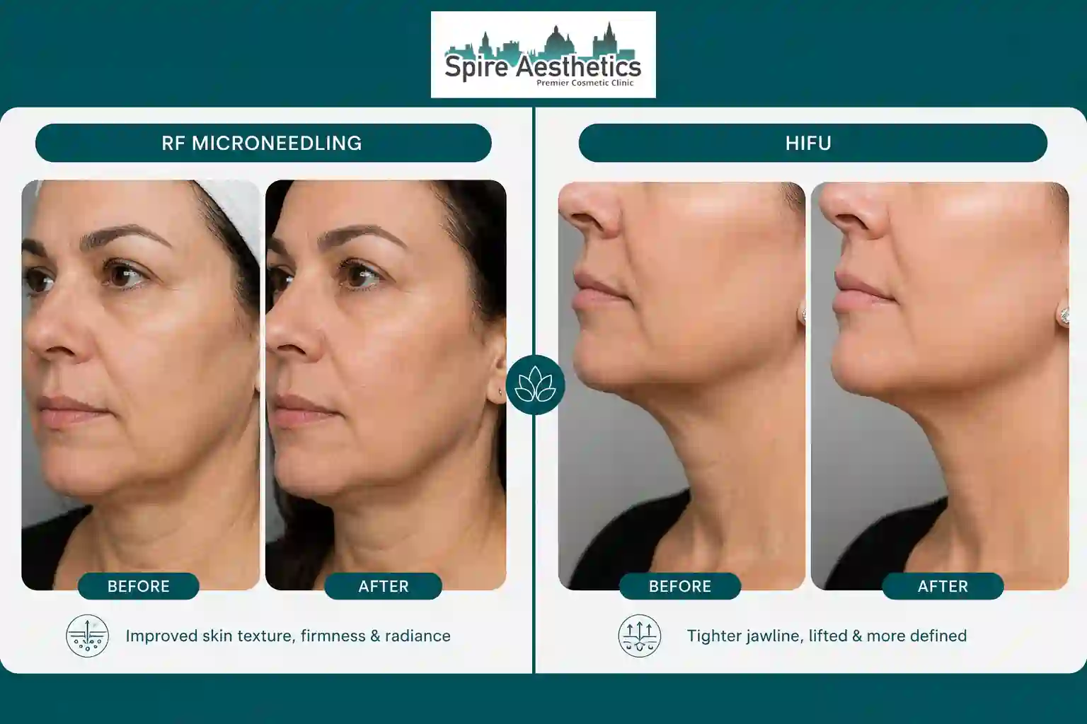 Can RF Microneedling and HIFU Be Combined Slough?