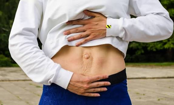 When Could Diastasis Recti Be the Missing Piece of the Puzzle Slough?