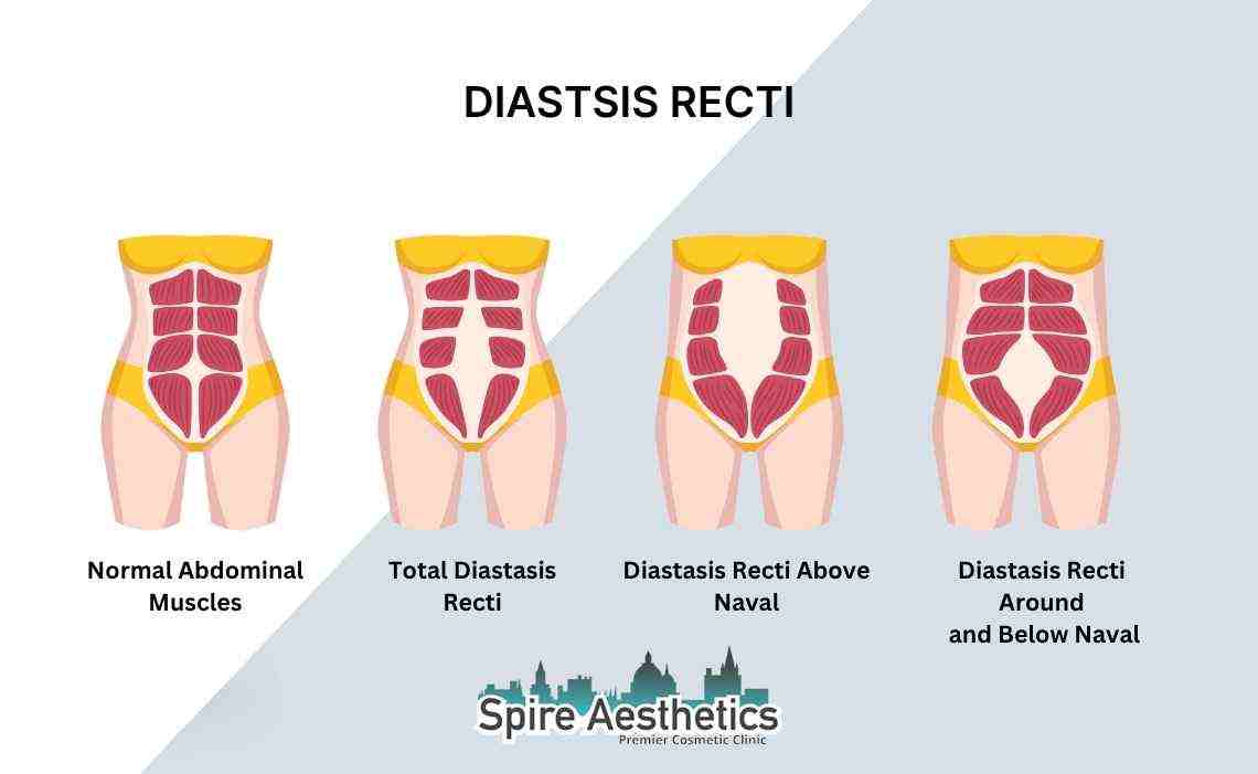 Is Non-Surgical Diastasis Recti Treatment Right for You? Common Concerns Answered Slough